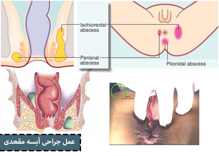 عمل جراحی آبسه مقعدی