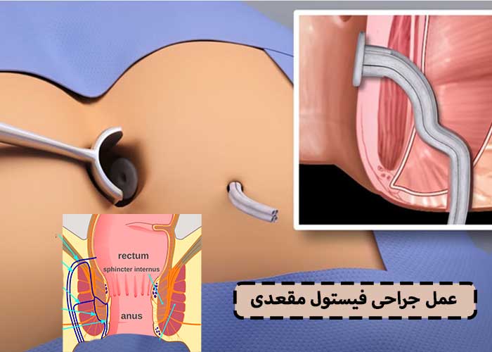 عمل جراحی فیستول مقعدی