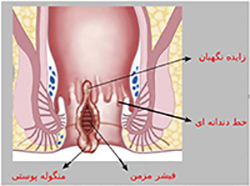 فیشر مزمن