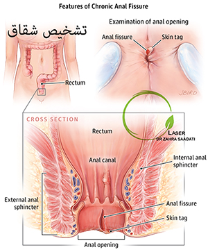 جراحی شقاق,درمان شقاق,عمل شقاق چگونه است,بهترین درمان شقاق,دکتر خانم شقاق,عمل جراحی شقاق,عمل شقاق