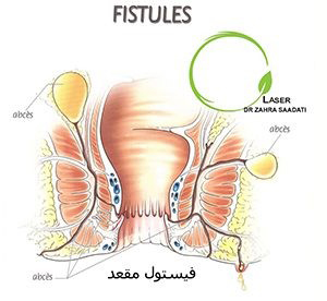 فیستول مقعد چیست,فیستول مقعد,بهترین درمان فیستول,عمل جراحی فیستول,فیستول, دکتر خانم فیستول ,بهترین دکتر فیستول مقعد, درمان قطعی فیستول,تشخیص فیستول مقعد, علایم فیستول مقعد,جراحی فیستول , انواع فیستول,لیزر فیستول