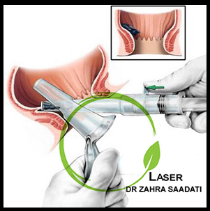 قیمت لیزر هموروئيد,درمان قطعی هموروئید,لیزر هموروئید تهران,بهترین درمان هموروئید,بهترین دکتر هموروئید