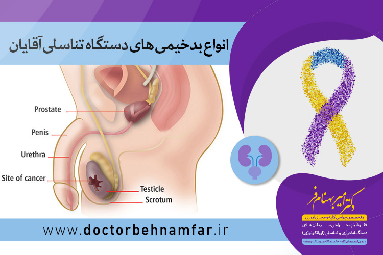 بدخیمی های دستگاه تناسلی آقایان