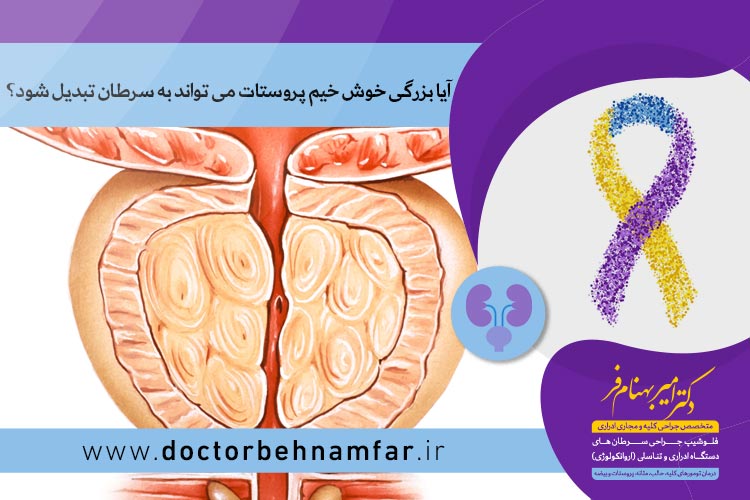 بزرگی خوش خیم پروستات