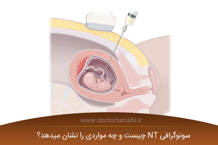 سونوگرافی ان تی