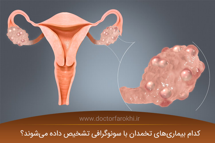 سونوگرافی تخمدان