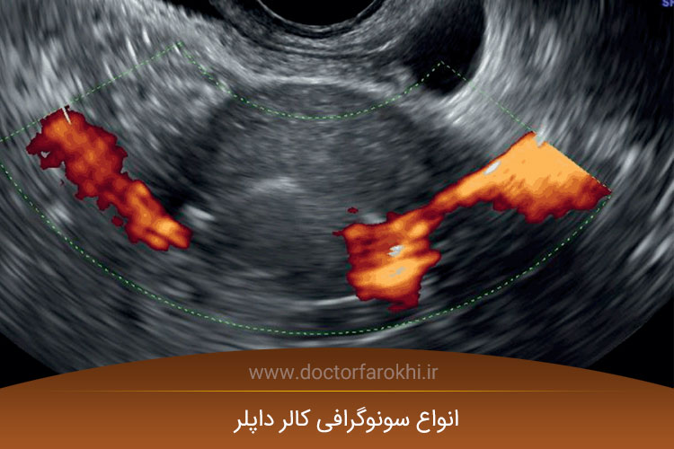 سونوگرافی کالرداپلر