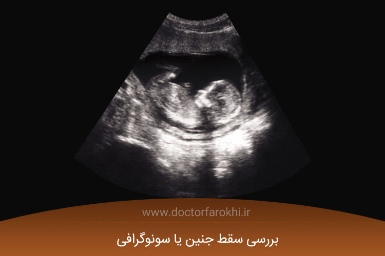 سونوگرافی سقط جنین
