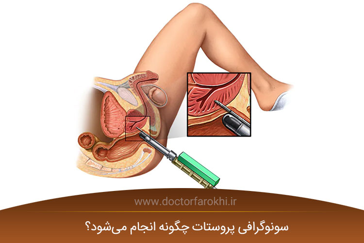 مزایای سونوگرافی پروستات