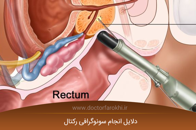 سونوگرافی رکتال