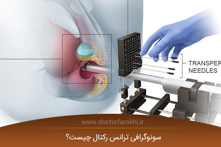 سونوگرافی ترانس رکتال