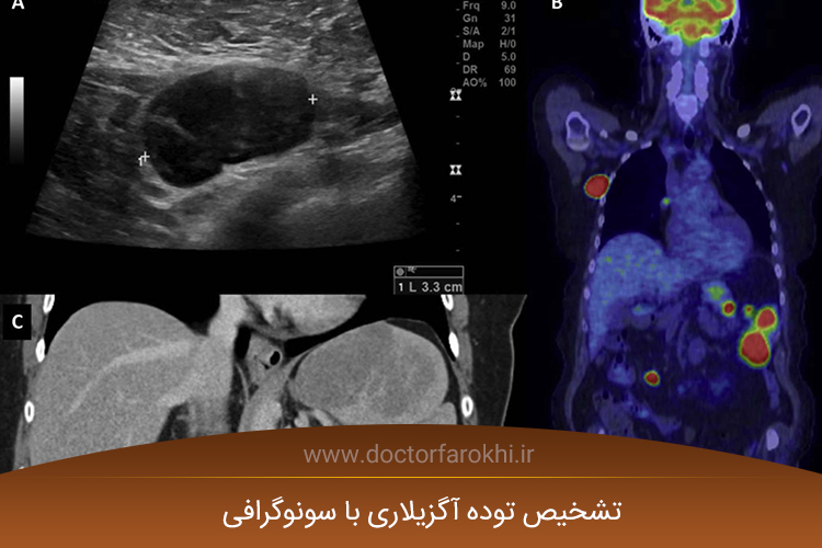 تشخیص توده آگزیلاری