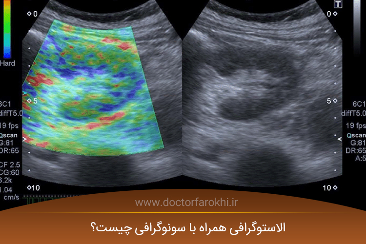 الاستوگرافی همراه با سونوگرافی