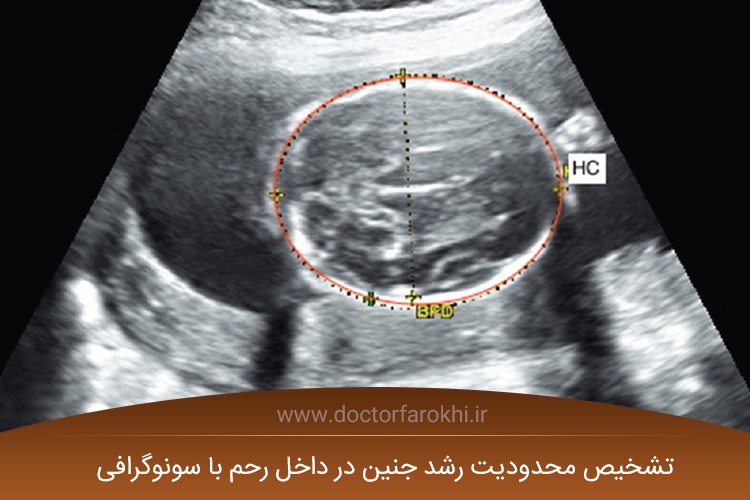 رشد داخل رحمی