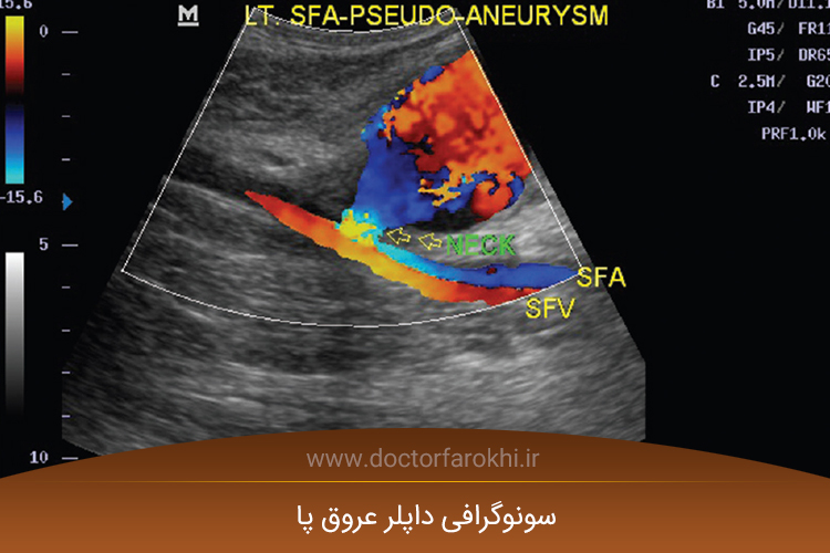 سونوگرافی داپلر عروق پا