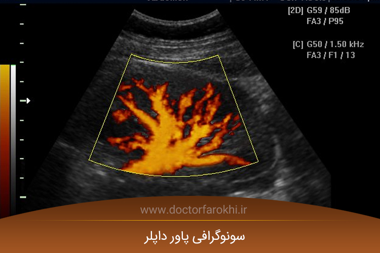 سونوگرافی پاور داپلر