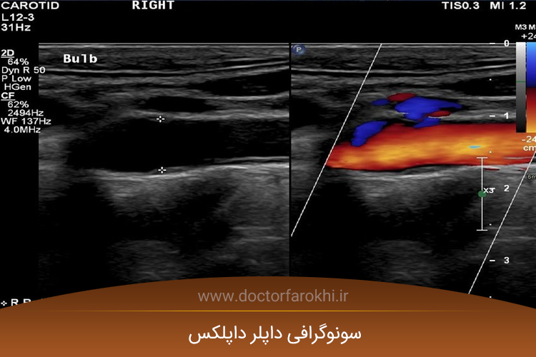 سونوگرافی داپلر داپلکس