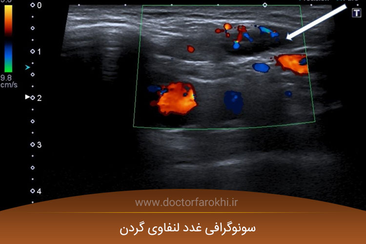 سونوگرافی غدد لنفاوی گردن 