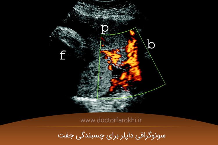 سونوگرافی داپلر برای چسبندگی جفت