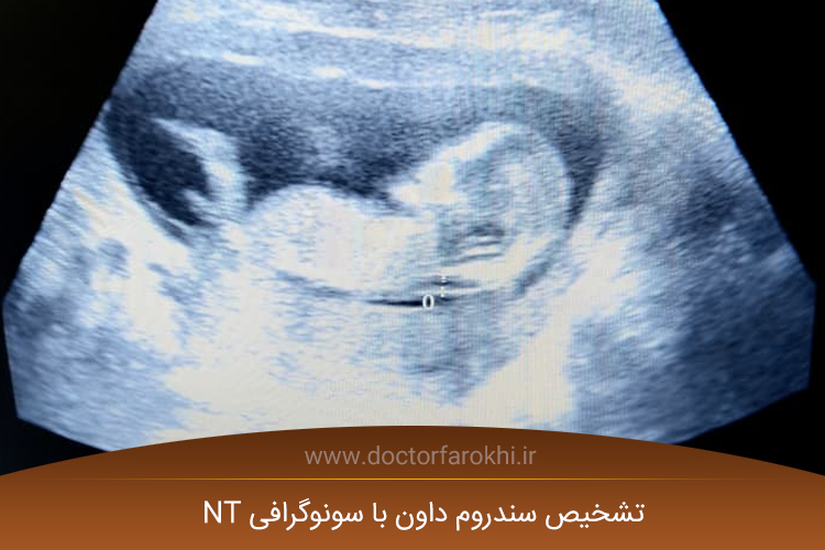 تشخیص سندروم داون با سونوگرافی