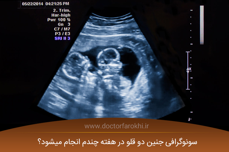 سونوگرافی جنین دو قلو