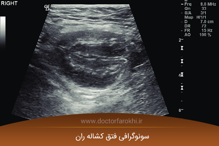 نحوه انجام سونوگرافی فتق کشاله ران