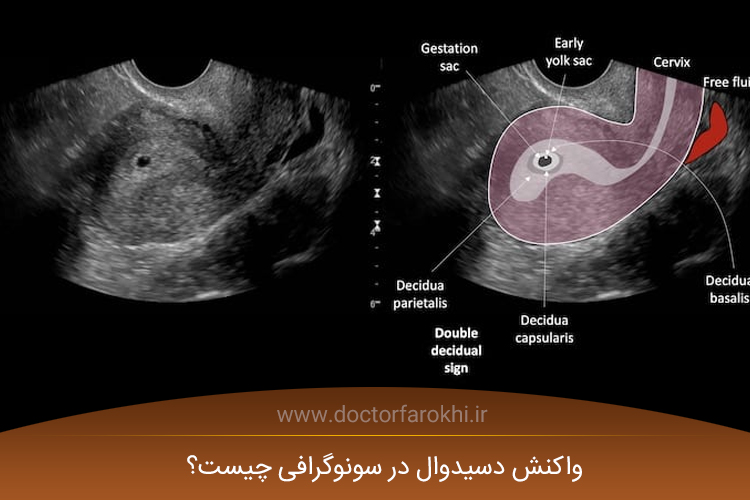 واکنش دسیدوال در سونوگرافی