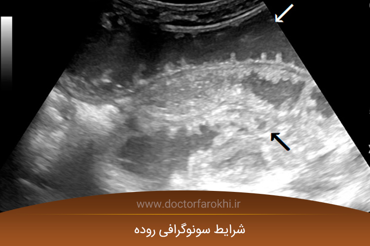 شرایط سونوگرافی روده