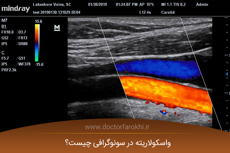 واسکولاریته در سونوگرافی