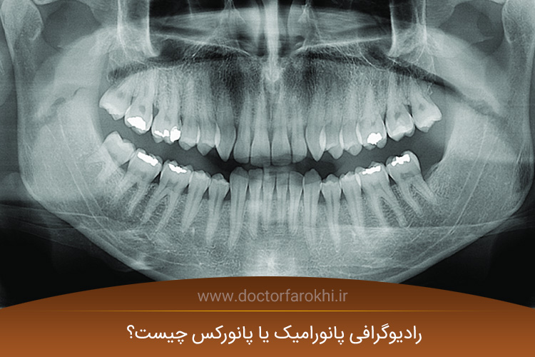 رادیوگرافی پانورامیک یا پانورکس