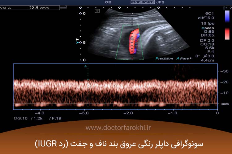 سونوگرافی داپلر رنگی