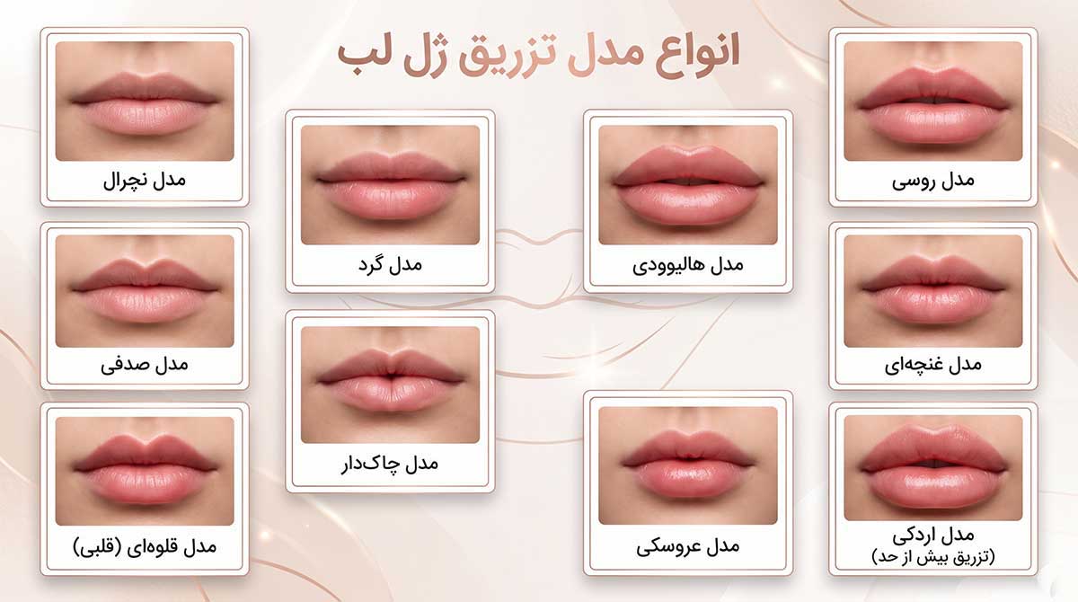 انواع مدل تزریق ژل لب