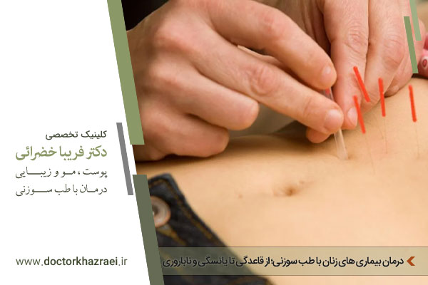 درمان بیماری زنان با کمک طب سوزنی