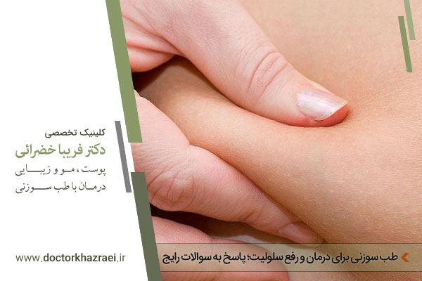 طب سوزنی برای درمان سلولیت