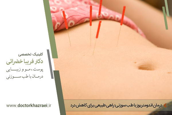 درمان قطعی و مقابله با اندومتریوز با طب سوزنی