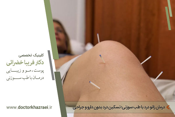 درمان زانو درد با طب سوزنی