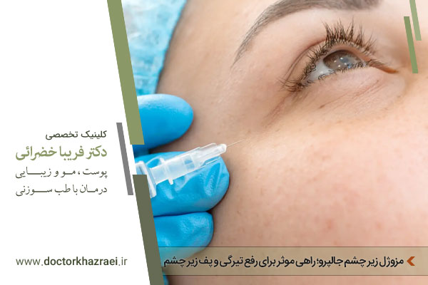 مزوژل جالپرو زیر چشم 