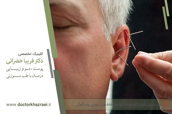 طب سوزنی گوش