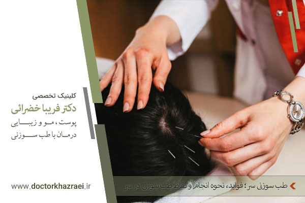 طب سوزنی سر