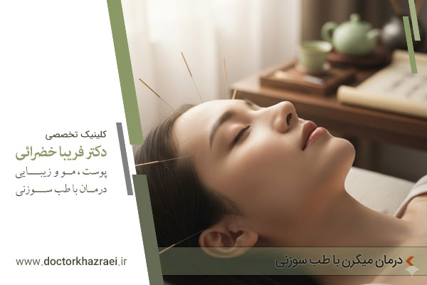 طب سوزنی برای درمان میگرن