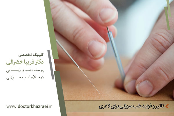 فواید طب سوزنی برای لاغری 