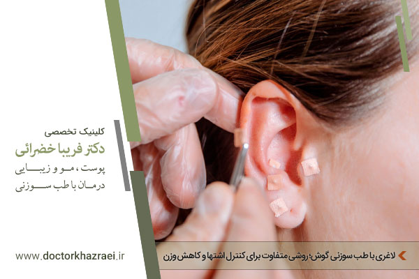 طب سوزنی گوش برای لاغری
