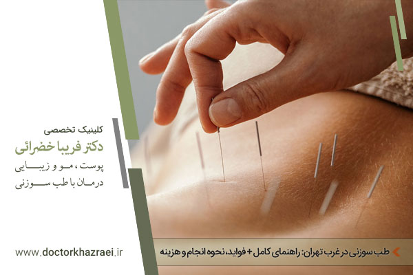 طب سوزنی غرب تهران
