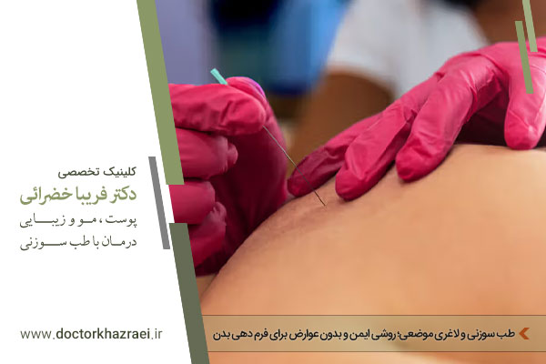 طب سوزنی و لاغری موضعی 