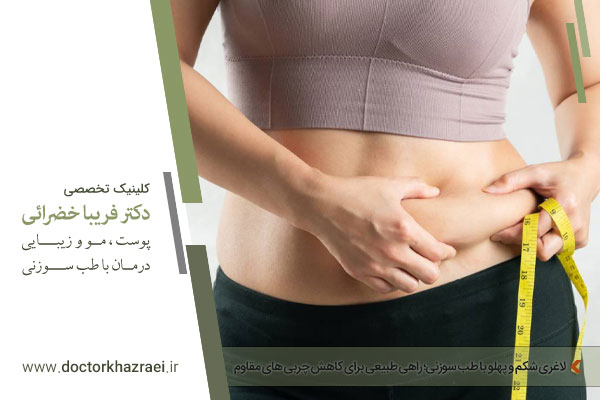 لاغری شکم و پهلو با طب سوزنی 