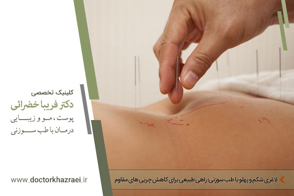 طب سوزنی لاغری شکم و پهلو 