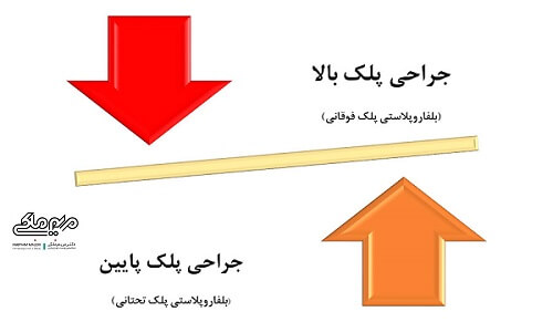 انواع جراحی پلک