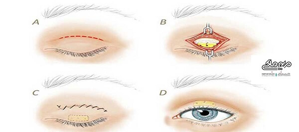 نحوه انجام جراحی پلک بالا