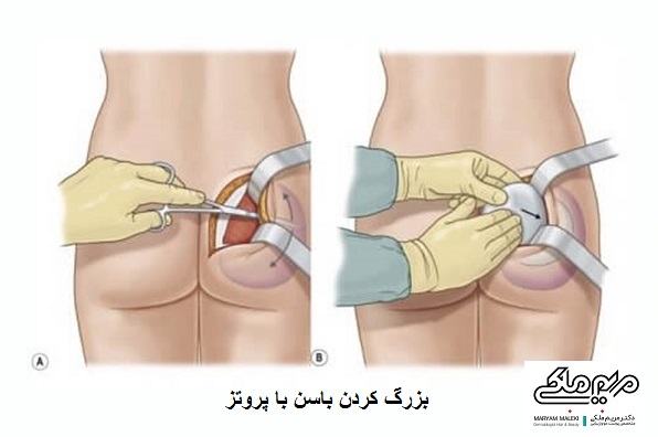 بزرگ کردن باسن با پروتز