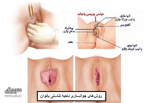 جوانسازی واژن در اصفهان